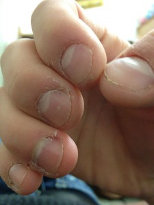800px-Nail_and_cuticle_bitting (1)